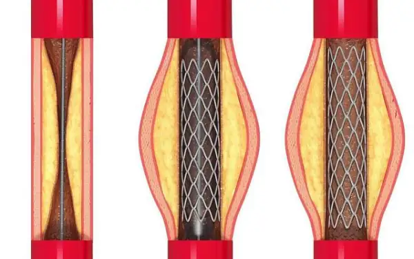 心脏支架价格未来会降下来么?-第7张图片-万福百科
