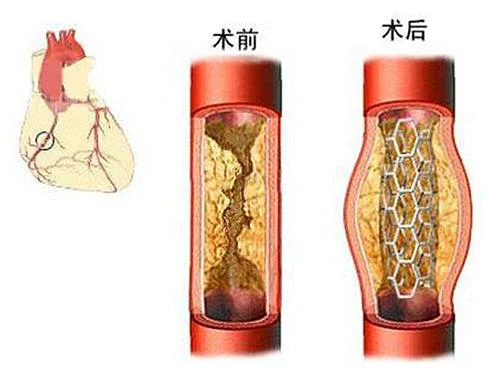 心脏支架价格未来会降下来么?-第13张图片-万福百科