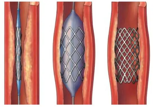 心脏支架价格未来会降下来么?-第18张图片-万福百科