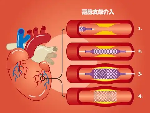 心脏支架价格未来会降下来么?-第8张图片-万福百科