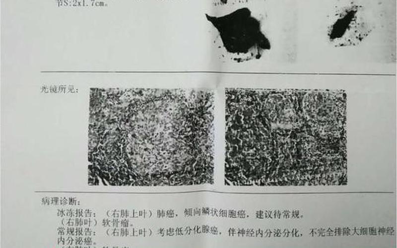 北京科兴是不是灭活疫苗 北京科兴肺结节：探寻肺癌早期筛查新突破-第1张图片-万福百科